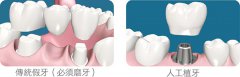 深圳固定义齿修复是怎么做