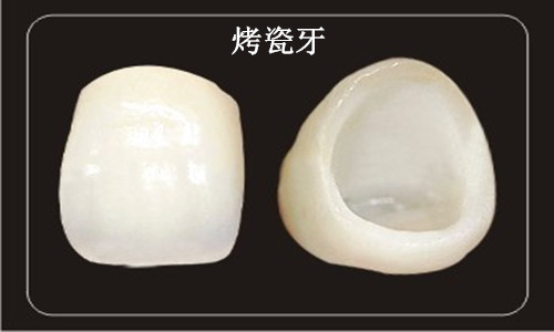 麦芽烤瓷牙