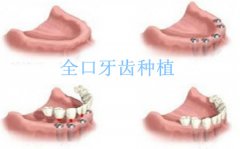 全口种植牙的价格是多少