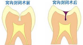 窝沟封闭的适应症和注意事项