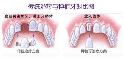 镶牙和种植牙对比.jpg
