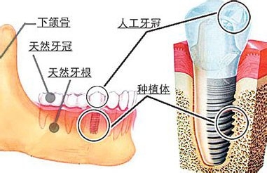 苏州美奥口腔即刻种植牙.jpg
