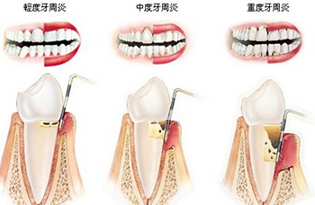 　　牙龈炎出现时的症状