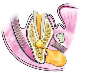 乳牙根尖周炎该怎样治疗