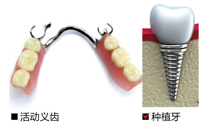 苏州美奥口腔补一颗大牙多少钱？