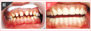 牙缝大矫正
