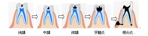　　龋齿