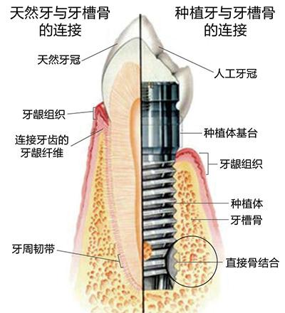 苏州美奥口腔即刻种植牙.jpg