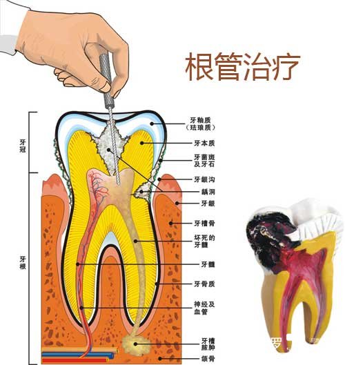 牙髓炎患者可以做根管治疗