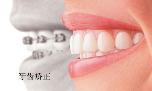 牙齿矫正