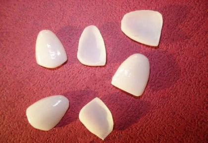 麦芽口腔明星3D瓷贴面相关问题解答