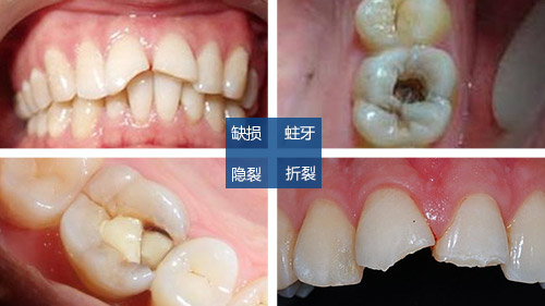 　　虫牙