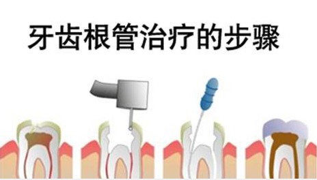 根管治疗的步骤