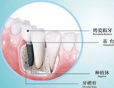 单颗牙齿种植4.jpg